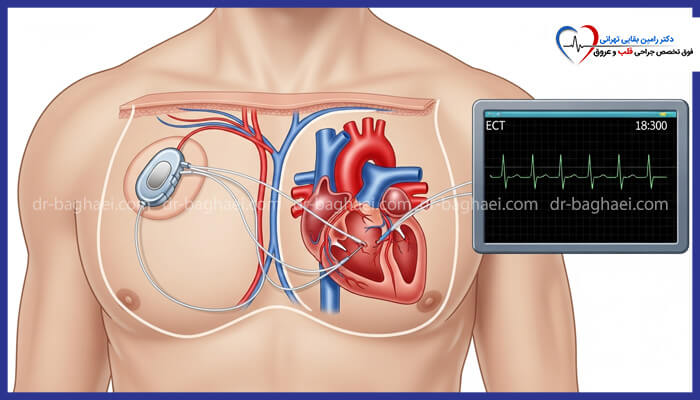 کاشت پیسمیکر در جراحی قلب بسته در زیر پوست قفسه سینه و اتصال لیدها به قلب، همراه با نمایش نوار قلب (ECG) بر روی مانیتور.
