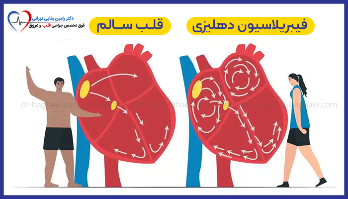 مقایسه قلب سالم و قلب مبتلا به فیبریلاسیون دهلیزی و تفاوت در جریان خون و ریتم دهلیزها