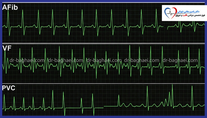  نمودار پزشکی که سه نوع الگوی مختلف نوار قلب (ECG) را نشان می‌دهد: فیبریلاسیون دهلیزی (AFib)، فیبریلاسیون بطنی (VF) و انقباض بطنی زودرس (PVC).