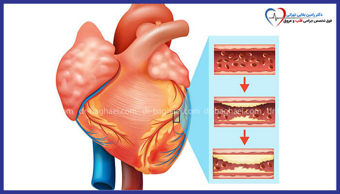 دیاگرام مراحل پیشرفت تجمع پلاک در عروق قلب و ایجاد بیماری ایسکمیک قلبی.