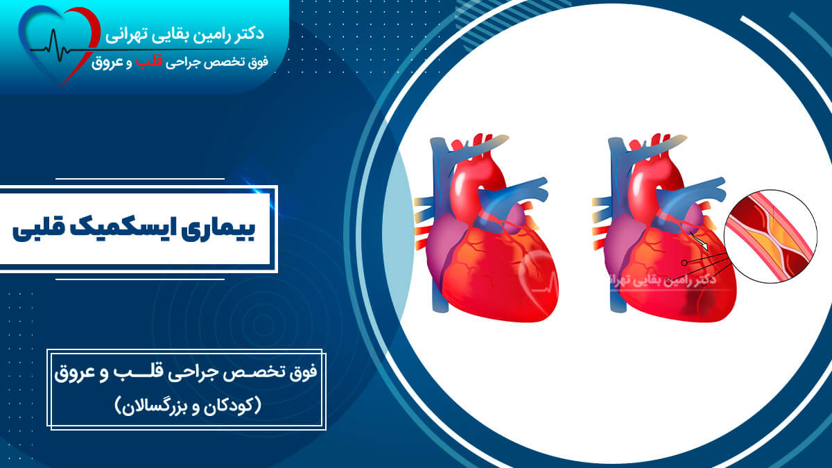 heart-ischemic-disease-comparison-diagram نمودار مقایسهای از قلب سالم و قلبی که در اثر بیماری ایسکمیک دچار تنگی عروق شده است.