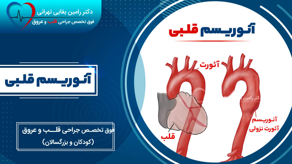 aortic-aneurysm-illustration تصویر شماتیک از آنوریسم قلبی