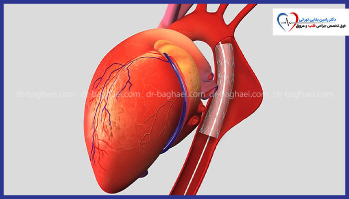 تصویر رندرینگ از عمل جراحی استنت‌گذاری در آئورت برای درمان آنوریسم