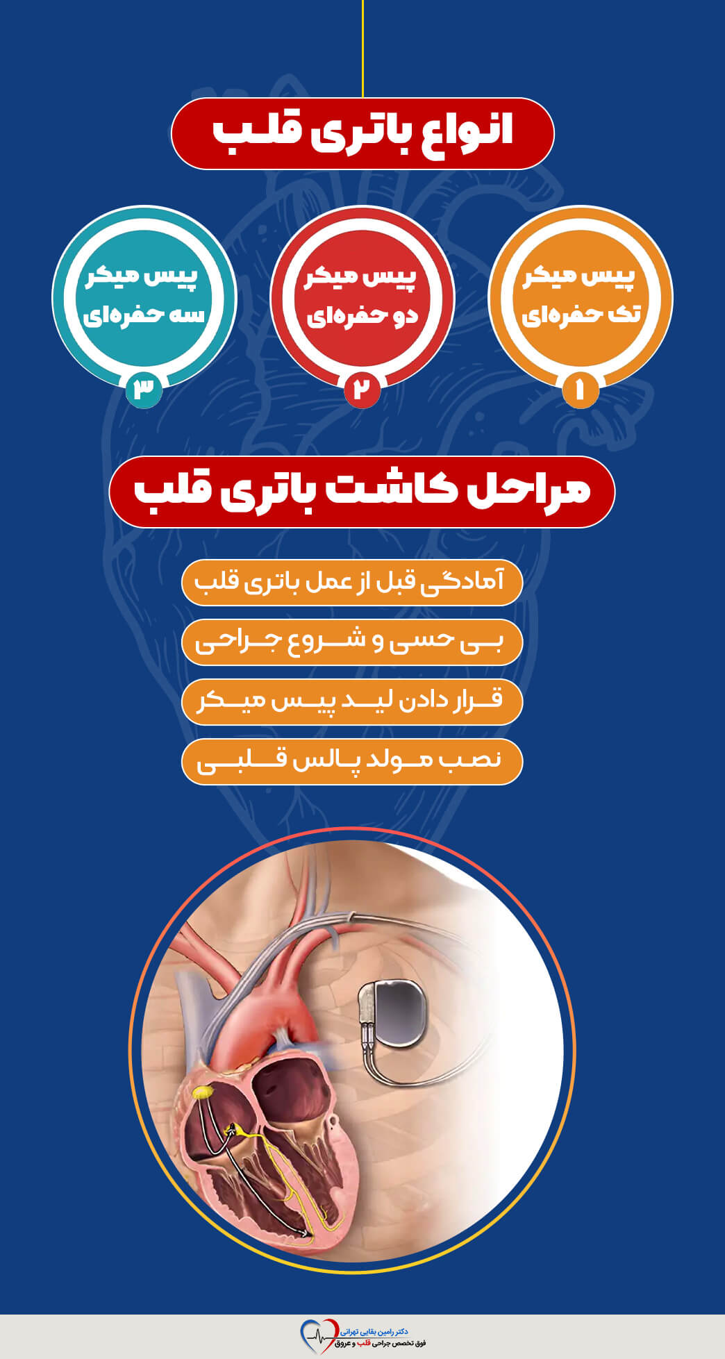اینفوگرافیک جامع انواع و مراحل کاشت باتری قلب (پیس میکر) شامل سه نوع پیس میکر (تک‌ حفره‌ای، دو حفره‌ای، سه‌ حفره‌ای) و چهار مرحله اصلی کاشت (آمادگی، بی‌حسی و شروع جراحی، قرار دادن لیدها، نصب مولد پالس). در پایین تصویر، شماتیک سه‌ بعدی از یک پیس میکر کاشته شده در بدن و متصل به قلب