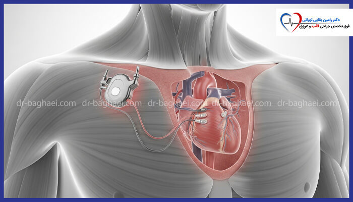 تصویر شماتیک بدن انسان که کاشت یک دستگاه تنظیم‌کننده ضربان قلب (پیس‌میکر) را در زیر ترقوه و اتصال لیدها به قلب را نشان می‌دهد.