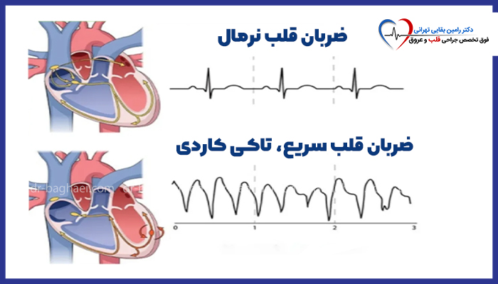 نمودار مقایسهای بین ضربان قلب نرمال و ضربان قلب سریع (تاکی کاردی) به همراه نمایش مسیر جریان الکتریکی در قلب.