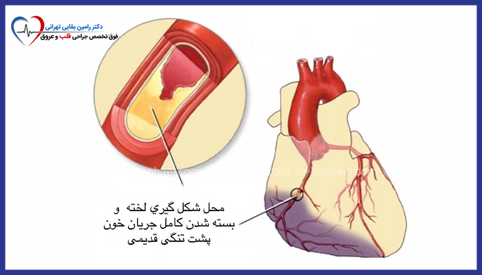 تصویر شماتیک از انسداد کامل جریان خون در رگهای قلب به دلیل تجمع چربی و ایجاد لخته خون.