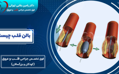 بالن قلب چیست؟