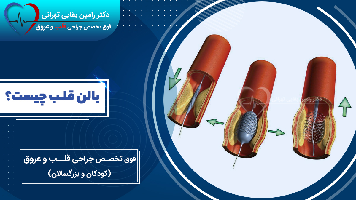 بالن قلب
