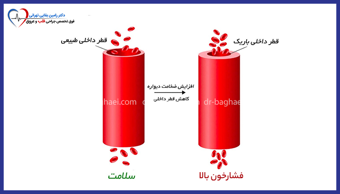 مقایسه قطر داخلی رگ خونی در حالت سلامت و حالت فشار خون بالا به همراه افزایش ضخامت دیواره رگ