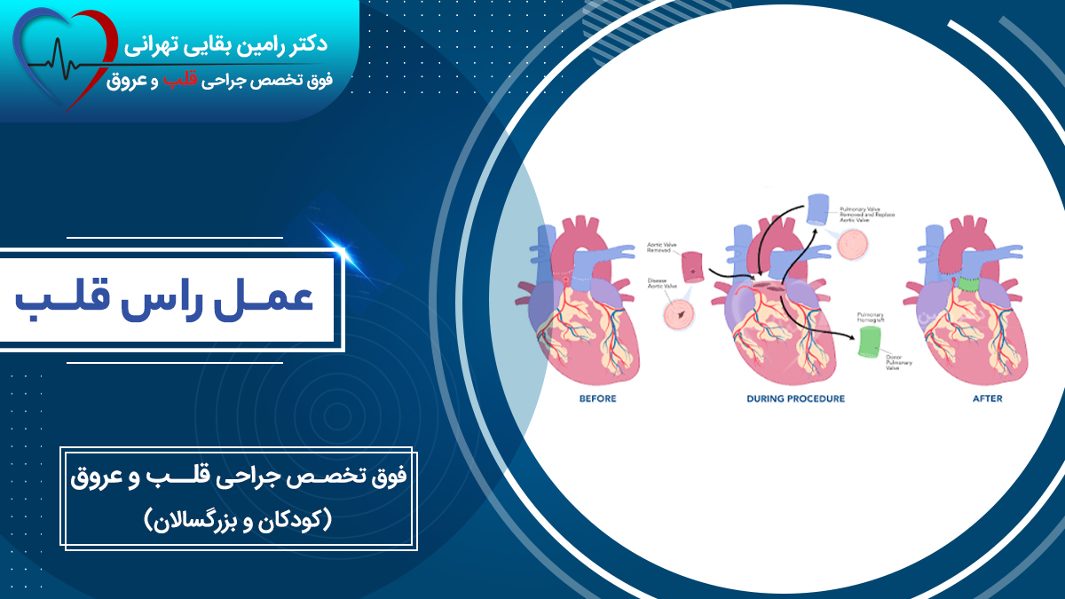 عمل راس قلب چیست و مراحل انجام جراحی راس